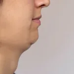 Best Treatment for Double Chin at Magnolia Medical & Aesthetics