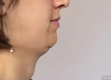 Best Treatment for Double Chin at Magnolia Medical & Aesthetics