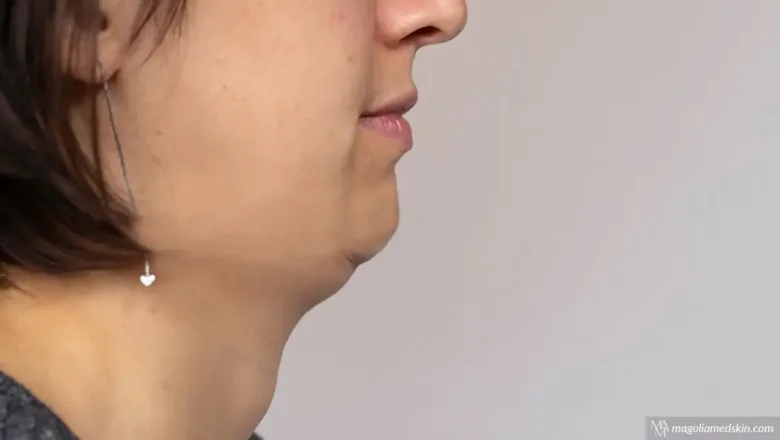 Best Treatment for Double Chin at Magnolia Medical & Aesthetics
