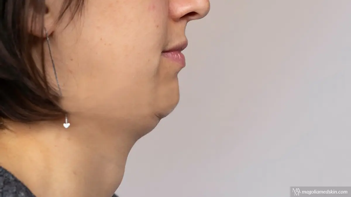 Best Treatment for Double Chin at Magnolia Medical & Aesthetics