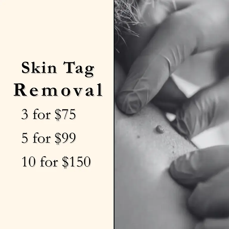 Skin tag removal special