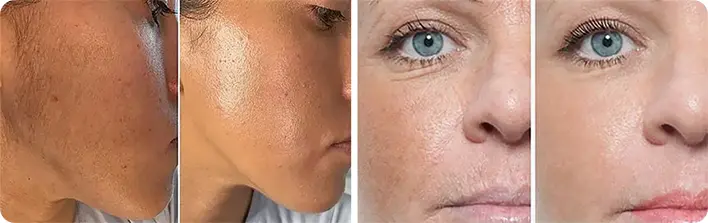 Get Baby Smooth Skin with Dermaplaning Treatment at Magnolia Medical & Aesthetics